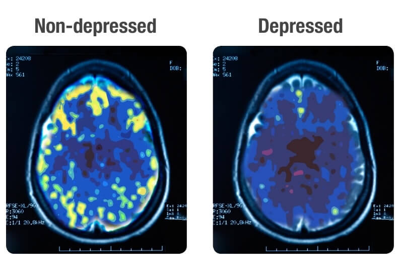depressed-brain-images